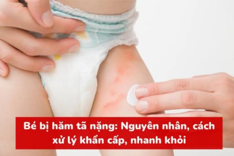 Dấu hiệu nhận biết hăm tã ở bé, da đỏ ửng, bé khó chịu